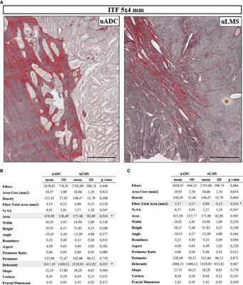 Characterizing the Invasive Tumor Front of Aggressive Uterine Adenocarcinoma and Leiomyosarcoma